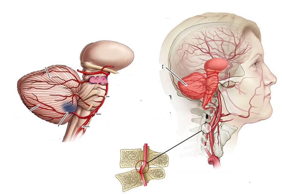 Cerebellar